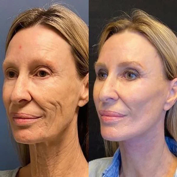 Botox Serum